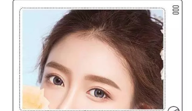 和阿姨的双眼皮做的太宽失败了