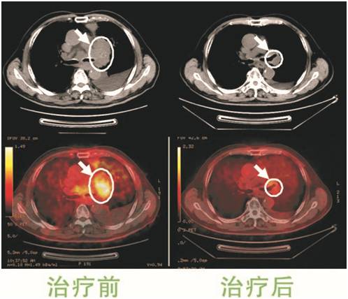 a45治疗癌症有效吗,a45治疗费用