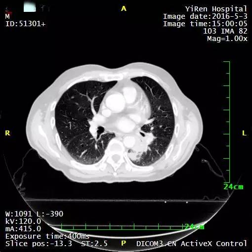 a45治疗癌症有效吗,a45治疗费用