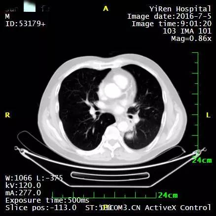 a45治疗癌症有效吗,a45治疗费用
