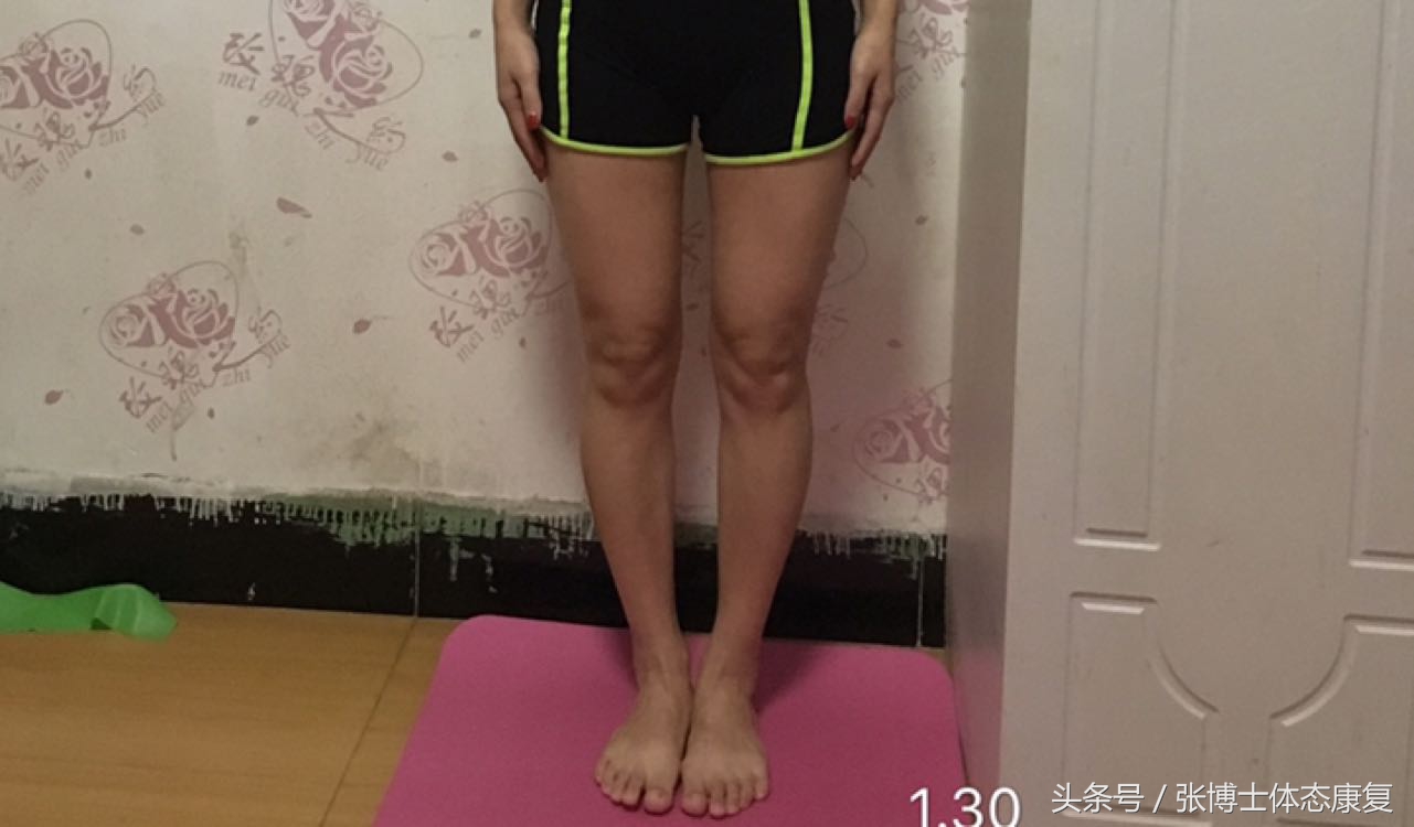 直腿术可以矫正天生o型腿吗,矫正o型腿最有效的锻炼动作直播