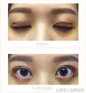 外科医生申霄,申霄医生双眼皮风格