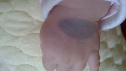 认识胎记,科普为什么很多婴儿有胎记