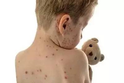 孕妇预防水痘最有效的方法,预防水痘传染病的宣传资料