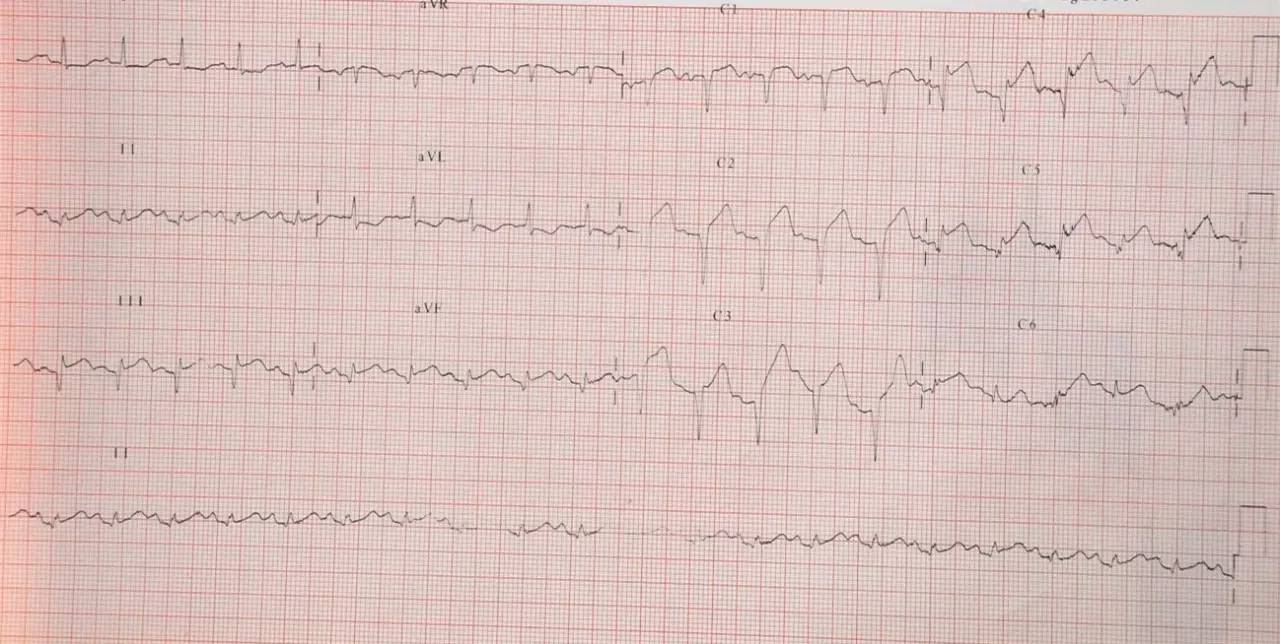 突发胸闷气短呼吸困难2小时,晚上突然胸闷睡不着要不要去医院