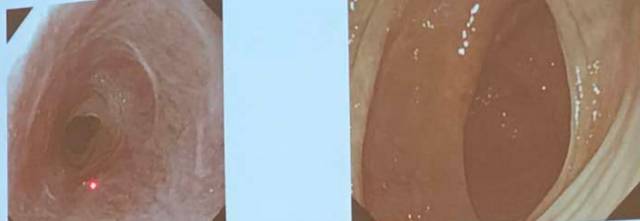 克罗恩病肠切除会好吗,克罗恩病会消化不良吗