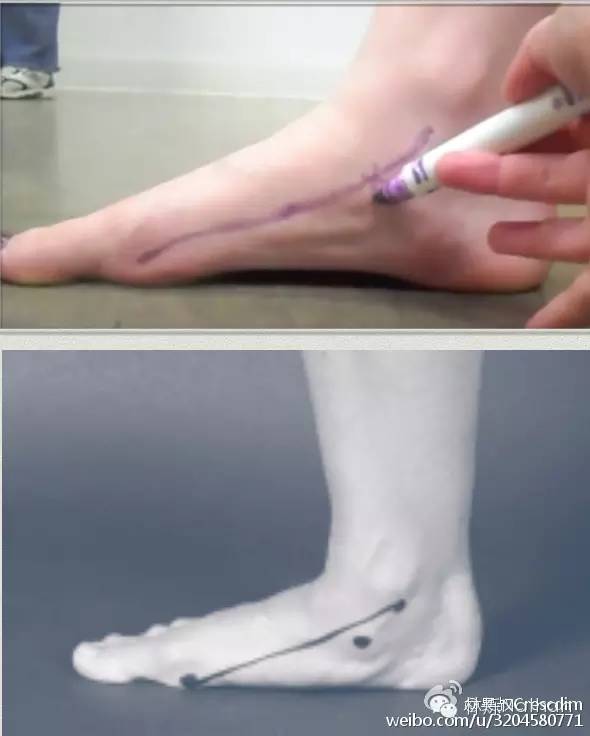 一只脚扁平足怎么矫正,瑜伽扁平足的矫正方法