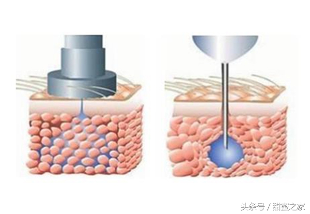 世界最前沿治糖尿病科技,世界最新糖尿病医学突破