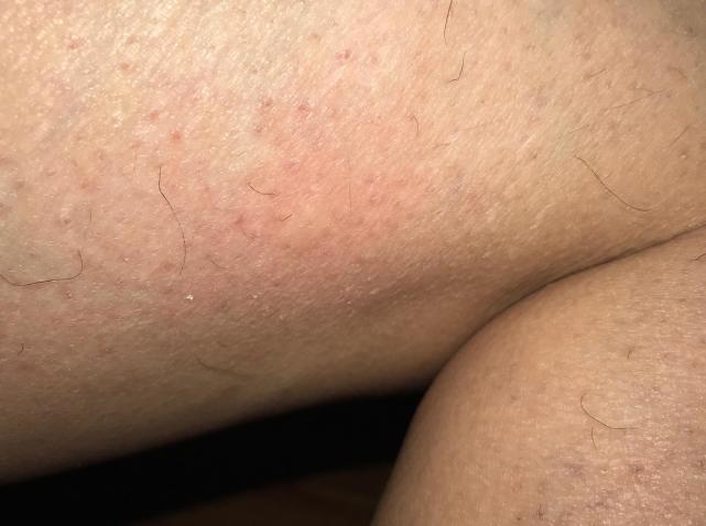 孩子小手被蚊子咬了后肿了,宝宝手被蚊子咬了个大包怎么办