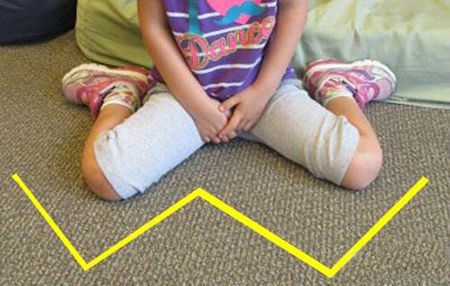 练习内八字走能纠正外八字走吗,外八字内八字怎么纠正