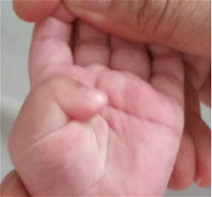 拇指内扣快速纠正的方法,一个月拇指内扣怎么矫正