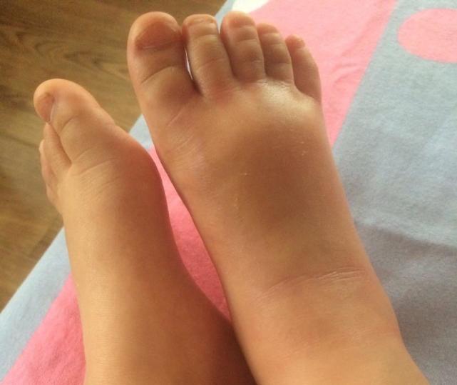 孩子小手被蚊子咬了后肿了,宝宝手被蚊子咬了个大包怎么办