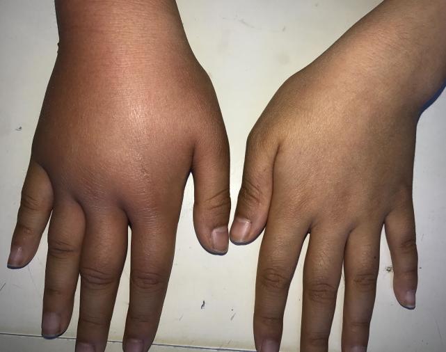 孩子小手被蚊子咬了后肿了,宝宝手被蚊子咬了个大包怎么办