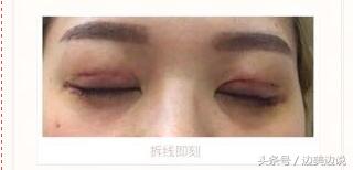 外科医生申霄,申霄医生双眼皮风格