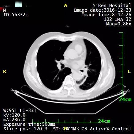 a45治疗癌症有效吗,a45治疗费用