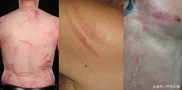 香菇过敏不及时治疗会怎么样,香菇和平菇一起同吃会中毒吗