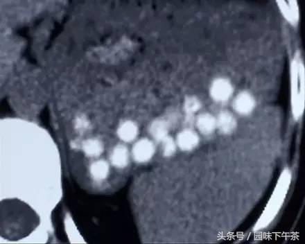 吸珍珠奶茶里的珍珠很危险,珍珠奶茶里的珍珠会卡在气管上吗