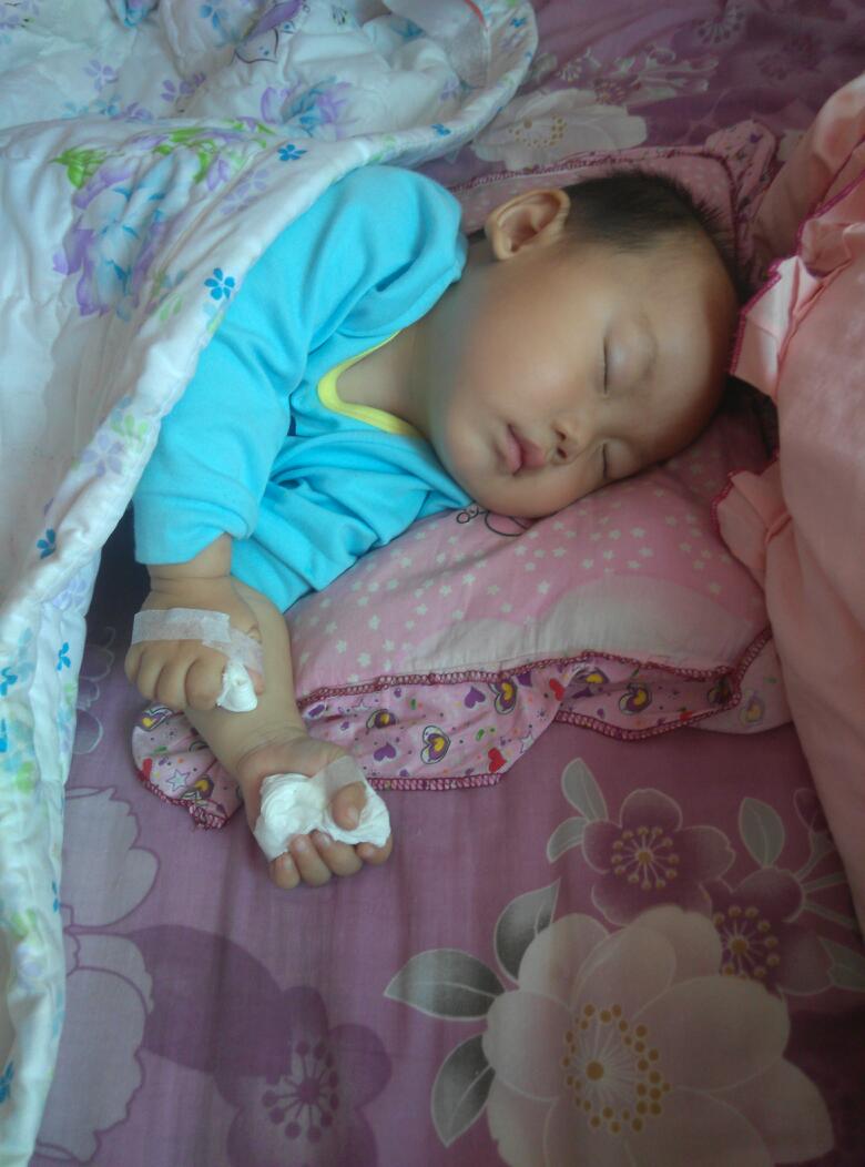 拇指内扣快速纠正的方法,一个月拇指内扣怎么矫正