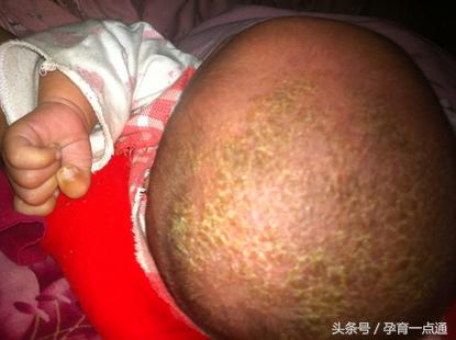 婴儿头上长乳痂反反复复要怎么办,婴儿乳痂掉了头皮红肿怎么办