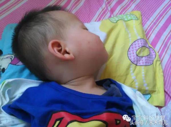 宝宝因为习惯导致的斜颈怎么纠正,大人抱姿导致宝宝斜颈