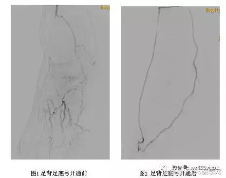 林少芒广医二院血管外科,血栓闭塞性脉管炎做什么检查