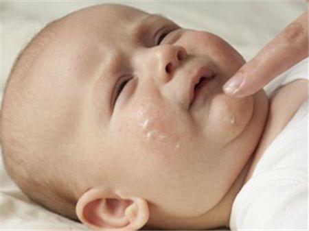 儿科医生宝宝湿疹怎么治,宝宝湿疹医生用药