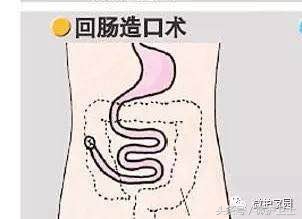 术后护理，肠造口术后如何训练规律排便