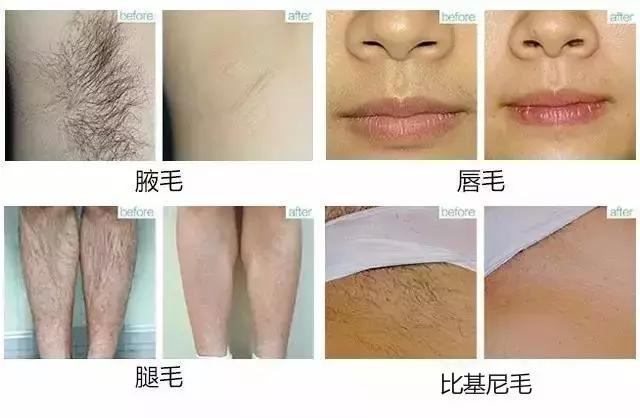 脱毛不小心刮掉一层皮怎么办,脱毛不小心刮伤补救