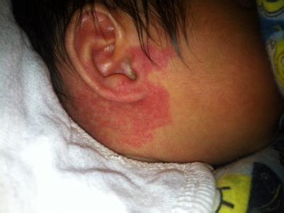 新生儿手上有青色胎记,新生儿易长的六种胎记