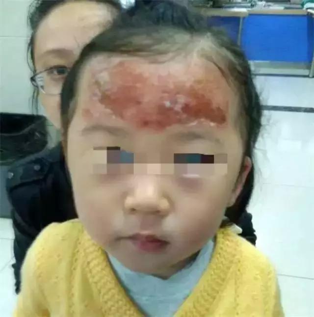 退烧贴过敏会全身起红疹吗,退热贴过敏皮肤有红斑