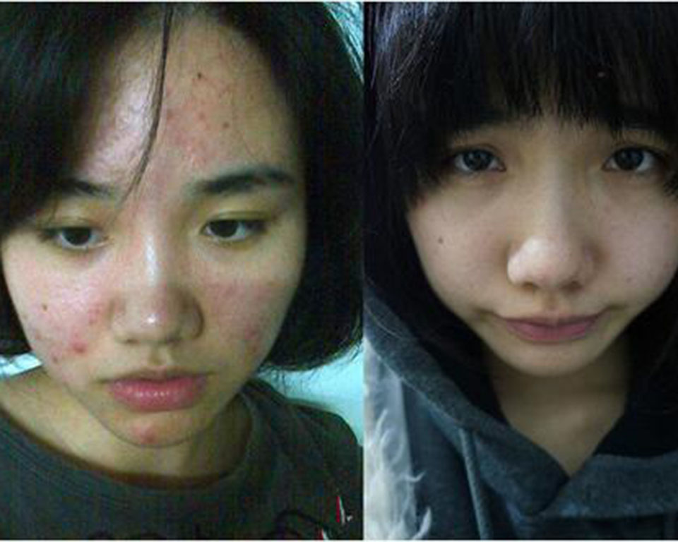 脸两侧长痘痘吃什么调理,脸上两侧长痘痘什么原因怎么解决