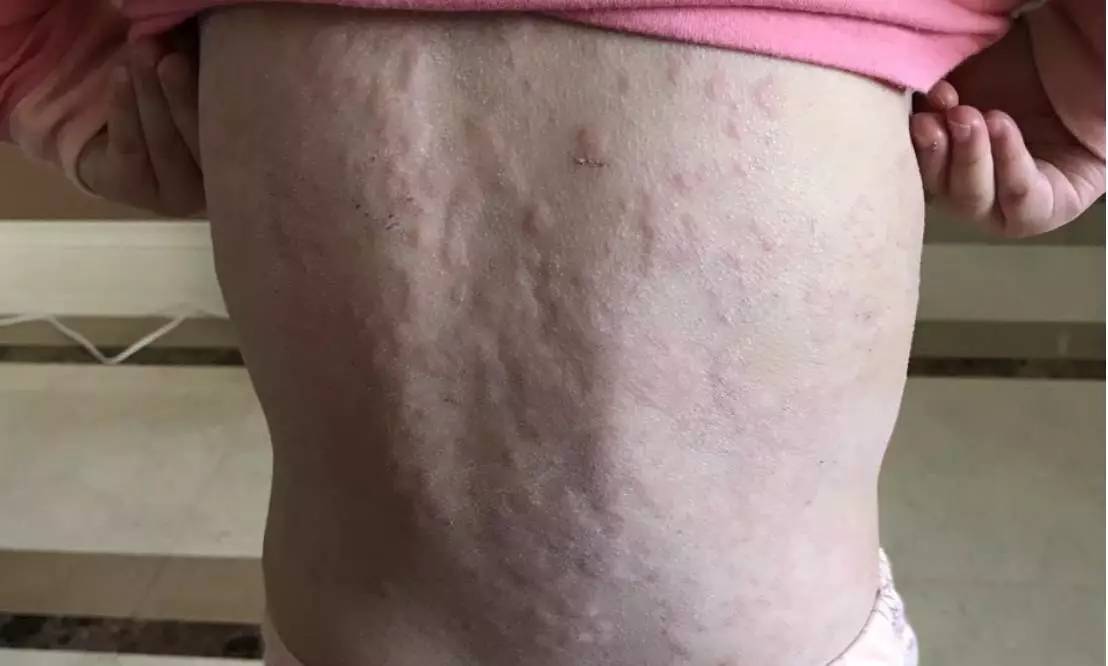 蚊子包止痒宝宝,怎么区分蚊子包和湿疹