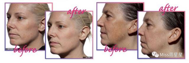 提拉紧致抗衰老美肤仪,提拉紧致美容仪效果最好的