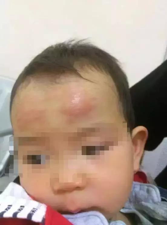 退烧贴过敏会全身起红疹吗,退热贴过敏皮肤有红斑