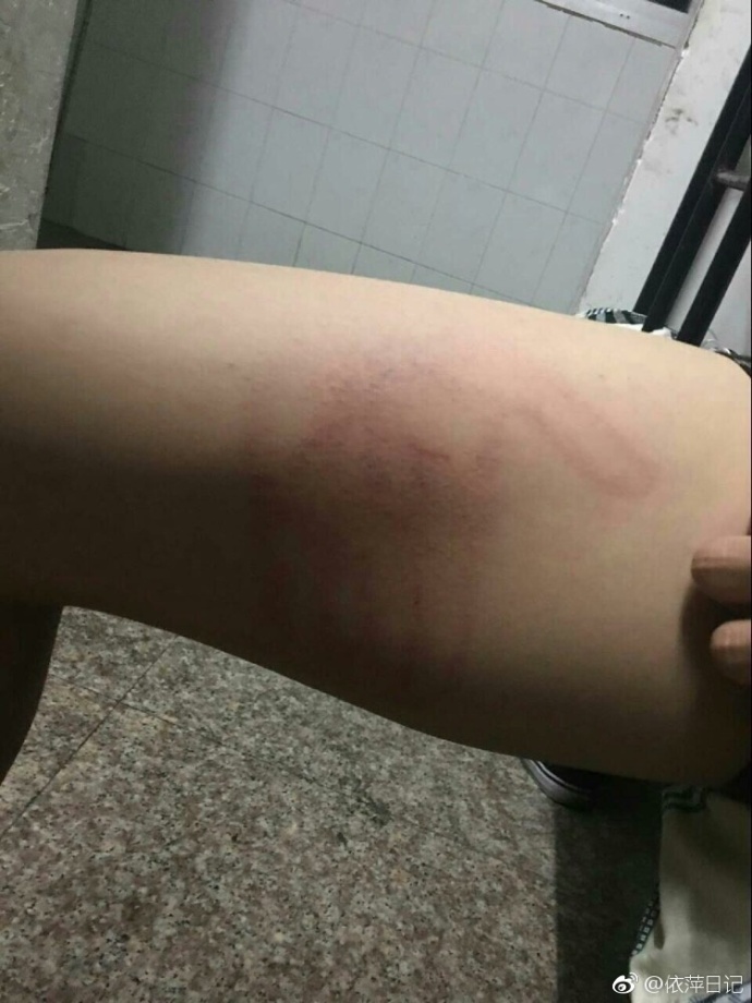 咽口水强迫症,总是想咽口水强迫症