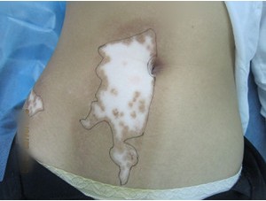 烫伤后的白癜风能治好吗,鳗鱼油膏能治好白癜风吗