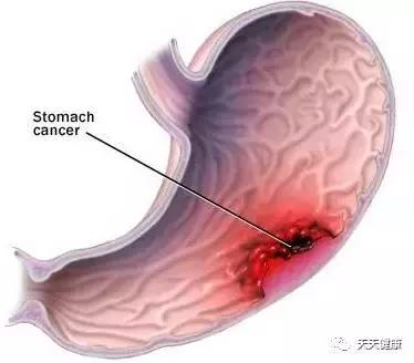 胃癌切除后饮食食谱大全,胃癌腹水饮食应关注什么