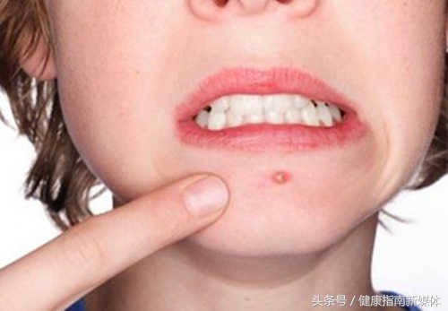 吃辣跟长痘有关系吗,吃点辣的下巴周围就长痘什么原因