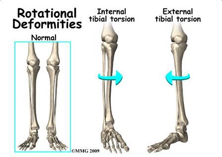 练习内八字走能纠正外八字走吗,外八字内八字怎么纠正