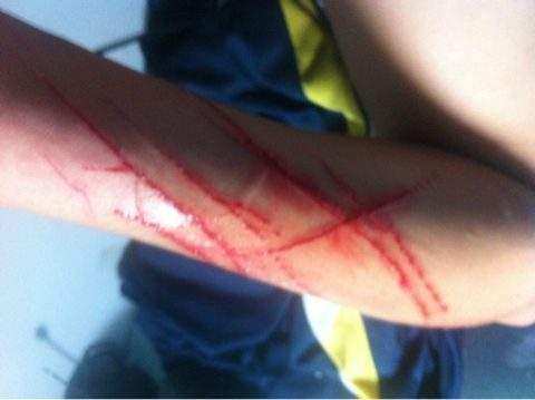 被家里猫咪抓伤了,打过疫苗的猫咪抓伤出血了怎么办