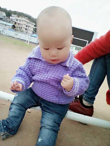 拇指内扣快速纠正的方法,一个月拇指内扣怎么矫正