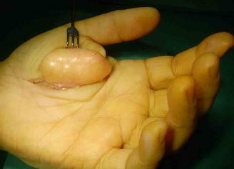 什么样的人最易得脂肪瘤,颈部脂肪瘤会致命吗