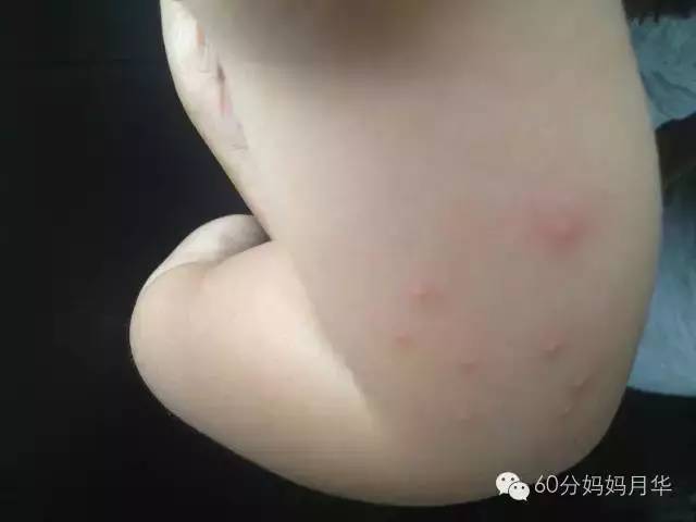 蚊子包止痒宝宝,怎么区分蚊子包和湿疹