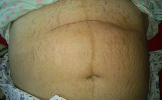 预防妊娠纹的按摩手法,孕期预防妊娠纹的按摩方法