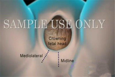 图片全程为你揭秘：产妇分娩侧切全过程