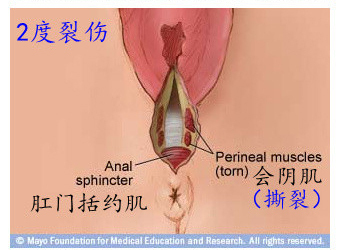 第67课：会阴侧切与撕裂