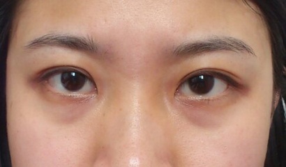 儿童下眼袋黑,你有黑眼圈