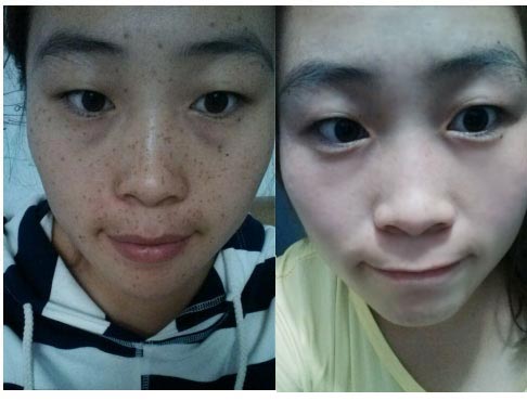 不花钱就能祛斑,不花钱有没有祛斑的方法