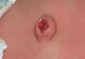 婴儿的脐部是什么东西,新生儿父母关注事项