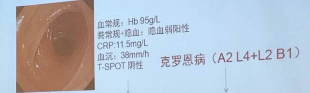 克罗恩病肠切除会好吗,克罗恩病会消化不良吗